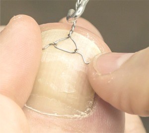 Nagelkorrekturspange bei Kindern und Babys