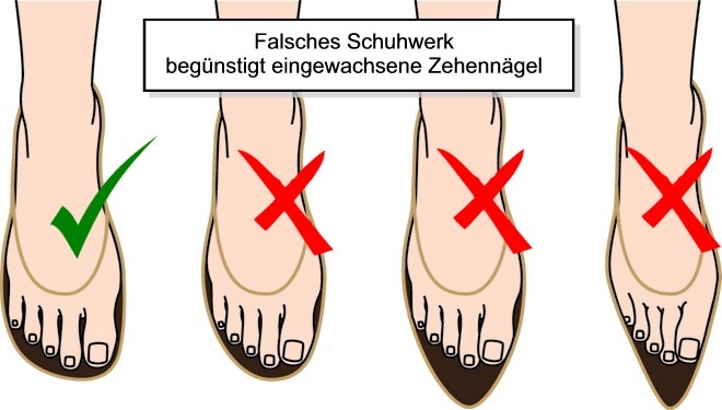Eingewachsene Zehennägel durch falsche Schuhe
