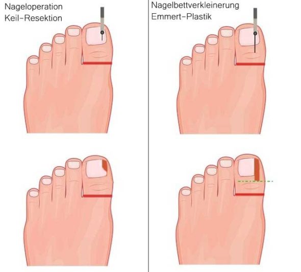 Operation bei eingewachsenem Zehennagel Infos zur Nagelbettverkleinerung
