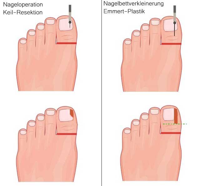 Eingewachsener Zehennagel Unterschied Keil- oder Wedge-Resektion zu Emmert Plastik