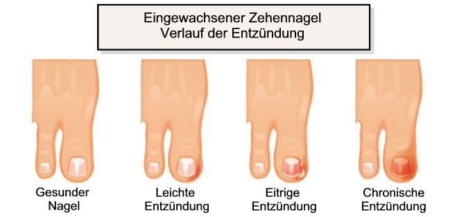 Verlauf der Entzündung bei einem eingewachsenen Zehennagel