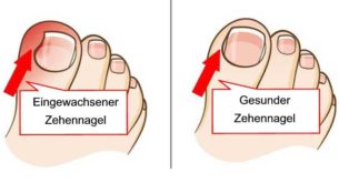 Gesunder Nagel / eingewachsener Nagel
