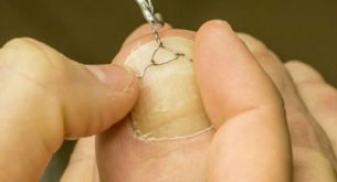 Nagelkorrekturspange / Orthonyxiespange