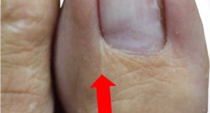 Operation Nagelbettverkleinerung