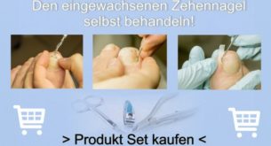 Eingewachsener Nagel selbst behandeln
