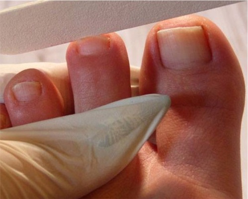 Fußnägel mit Nagelpilz schneiden